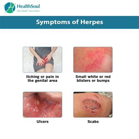 Yes, men can have herpes without having any symptoms. . Herpes urethritis without sores
